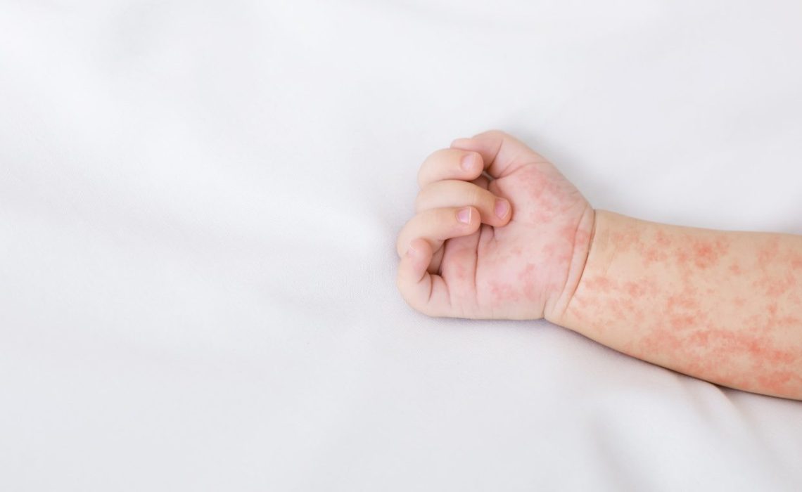 Hand of newborn baby with measles rash on white sheet, closeup, panorama with free space