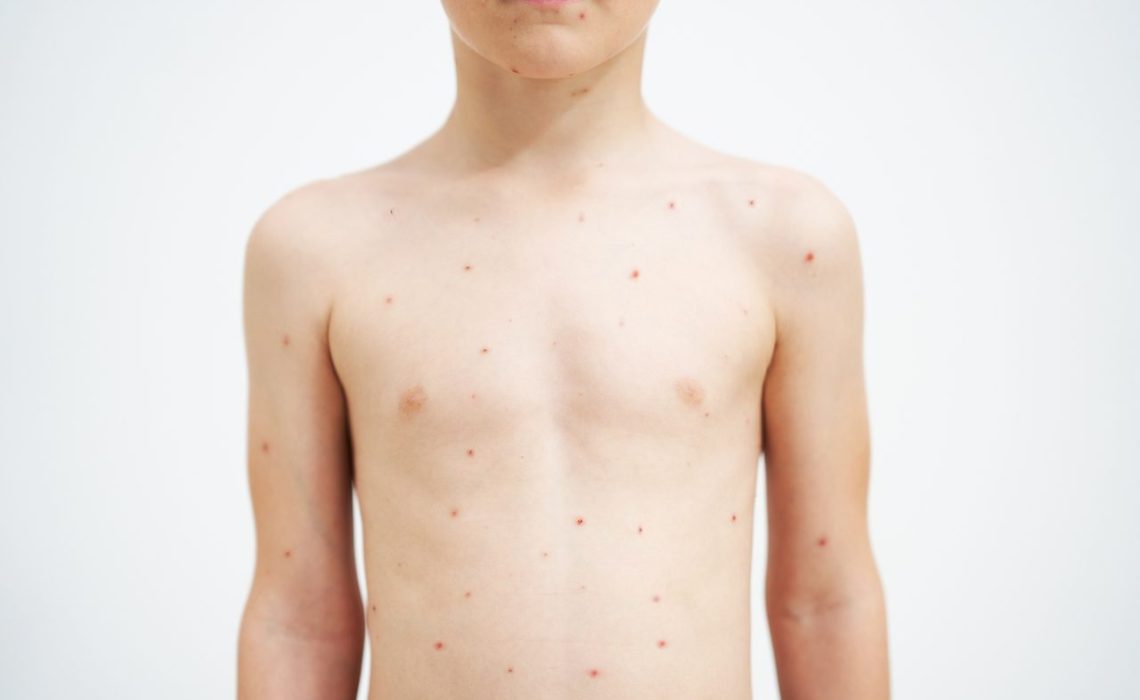 Young boy having chickenpox pictures of skin. High quality photo